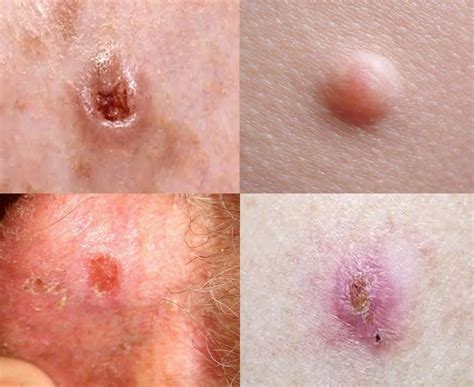 skin cancer photos on stomach